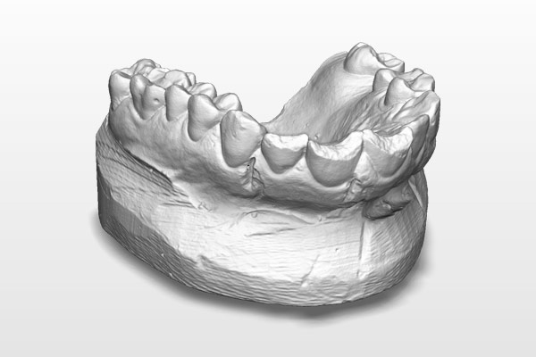 Dental mold 3d scan